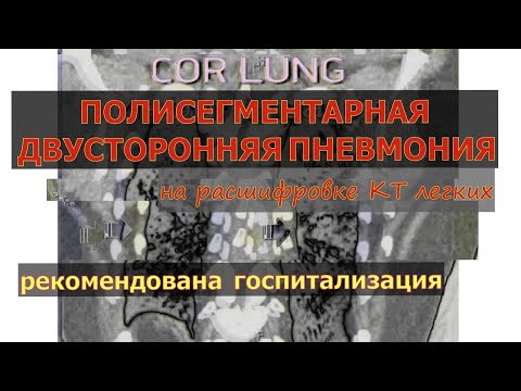 ПОЛИСЕГМЕНТАРНАЯ ДВУСТОРОННЯЯ ПНЕВМОНИЯ на расшифровке КТ легких с рекомендацией К ГОСПИТАЛИЗАЦИИ