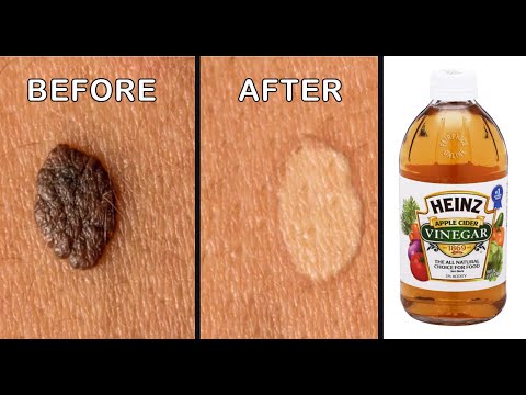 Mole Removal By Apple Cider Vinegar || Effective Ways to Remove Skin Tags Naturally