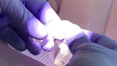 Insertion of night guard for clenching and grinding