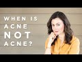 When is Acne NOT Acne? Decoding Fungal Acne | Dr Sam Bunting