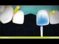 La solution instantanée pour remplacer les dents absentes -- everStickC&B .wmv