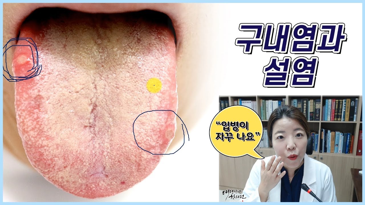 입병 구내염 설염이 자주 나는 분 보세요 - YouTube