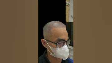 Hói chữ M sẽ làm bạn già nhiều đi, cách cải thiện nó kiểu tóc chữ m trán cao.Xăm tóc hói #xămtóc