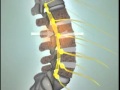 What is Spinal Stenosis? - Lumbar Spinal Stenosis - DePuy Videos