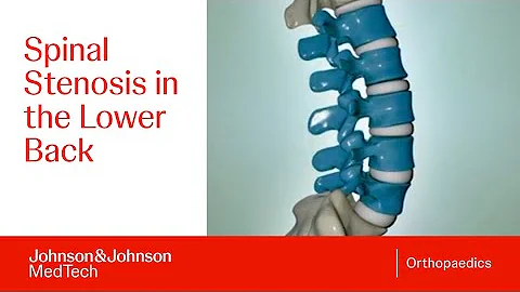 What is Spinal Stenosis? - Lumbar Spinal Stenosis ...
