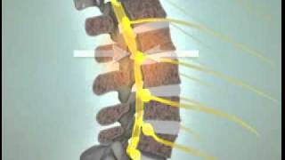 What is Spinal Stenosis? - Lumbar Spinal Stenosis - DePuy Videos