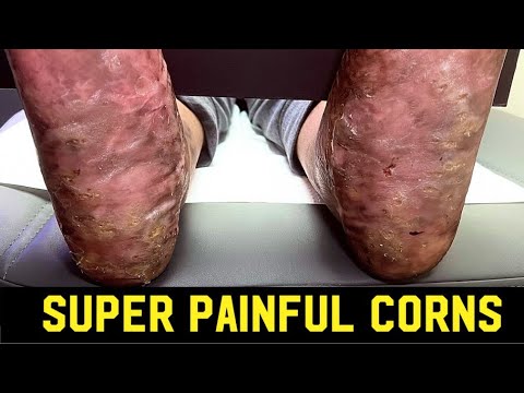DEBRIDEMENT & SHAVING OF COUNTLESS EXCRUCIATING CORNS