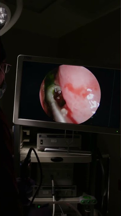 Removing a Sinus fungus ball from a patient’s nose! #nose #allergy #allergies #snot