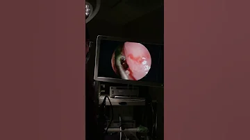 Removing A Sinus Fungus Ball From A Patient S Nose Nose Allergy Allergies Snot 
