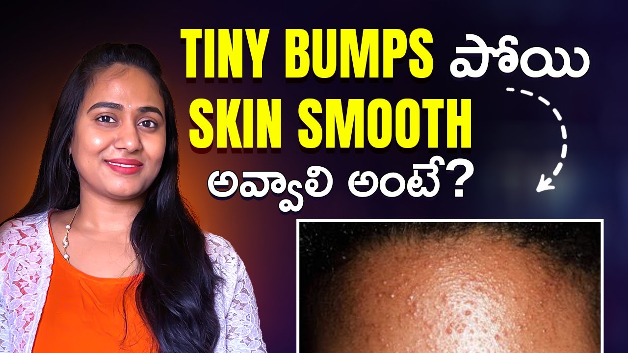 Face మీద TINY BUMPS పోవాలంటే ఎం చెయ్యాలి || @bestbeautystelugu