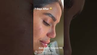 7 Days After Rhinoplasty | Dr. TAS