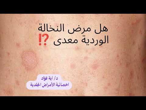 هل مرض النخالة الوردية معدى