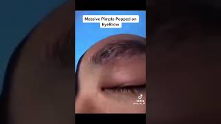 MASSIVE Pimple Popped on Eyebrow...The biggest Eyebrow pimple I have ever seen #pimplepopping