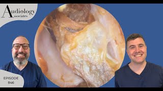 ITCHY EAR CANALS FIXED & ANTERIOR RECESS EAR WAX REMOVAL - EP846
