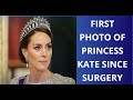 Unveiling the mystery princess kates postprocedure photograph  one world one smile