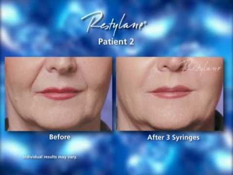 Restylane Facial Filler