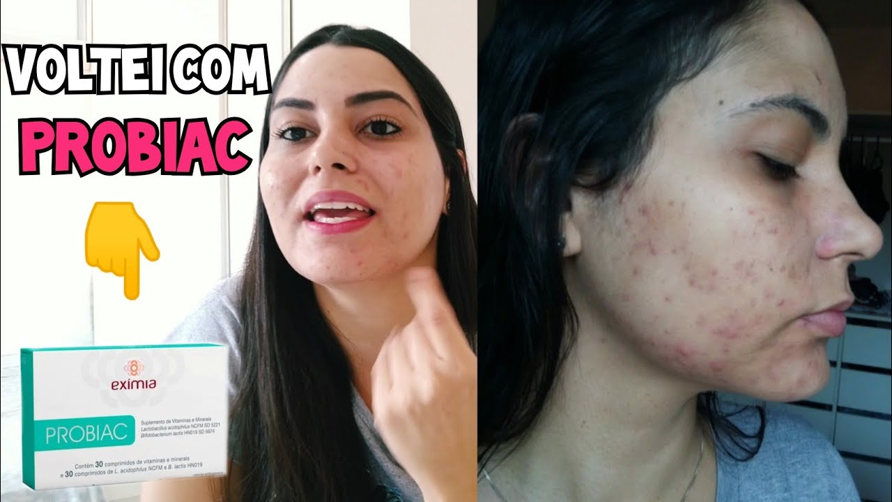 RELATO DA MINHA PELE COM ACNE | VOLTEI A TOMAR PROBIAC EXIMIA | ACNE ...