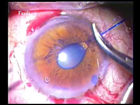 pseudoexfoliation - small pupil phaco - YouTube