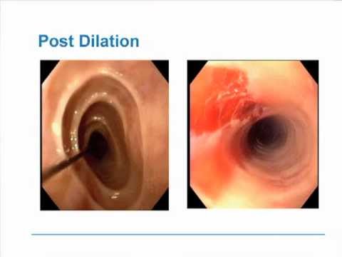 Eosinophilic Esophagitis