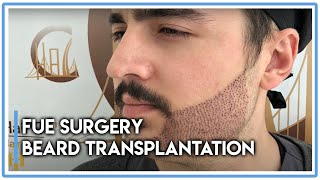 FUE Surgery: Beard Transplantation in Hair of Istanbul [Great Results!]