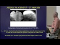 Cervical Radio-frequency Neurotomy Techniques by Mario De Pinto, M.D.