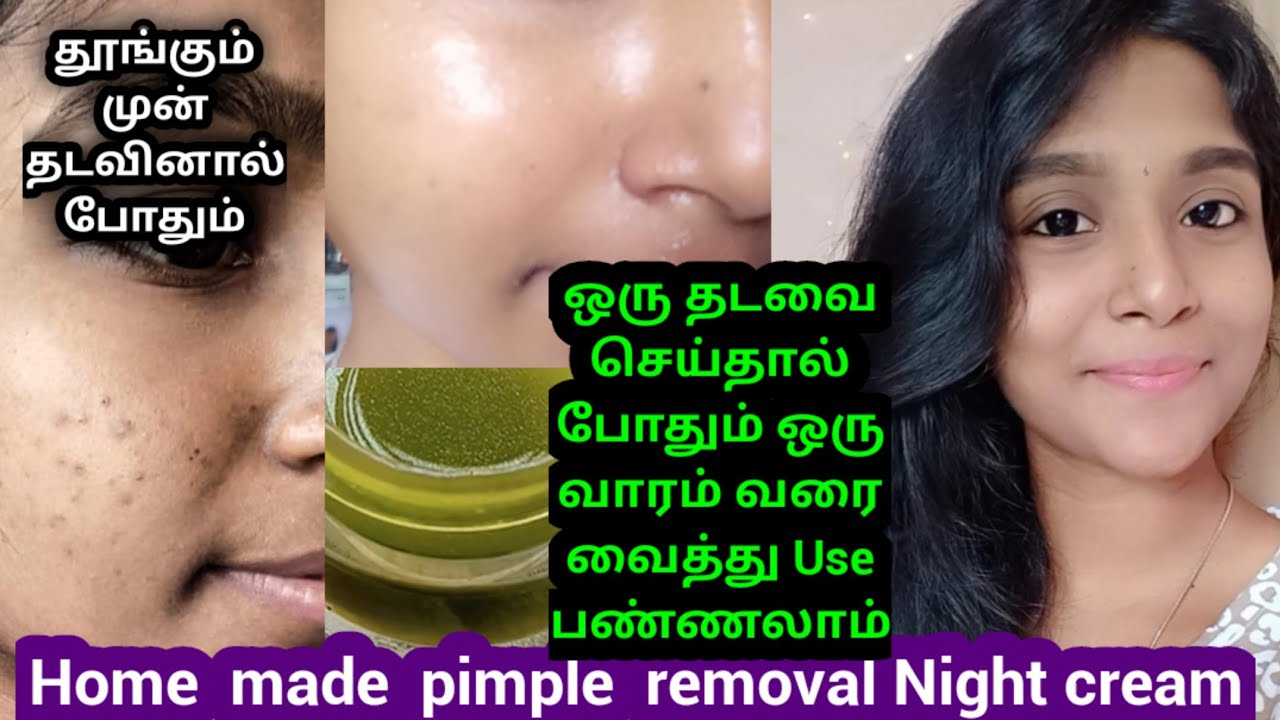Pimple removal cream/ Home made pimple removal cream/ gayus lifestyle