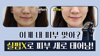실펌X로 피부 새로 태어난 후기! 전후 모습으로 확인👀