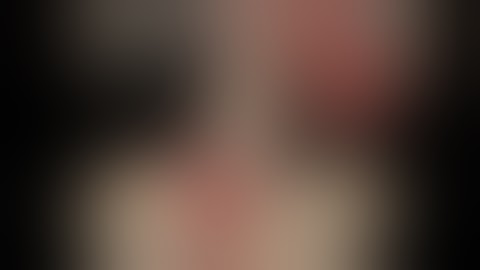 Lap Pyeloplasty Pelvic Kidney for PUJ obstruction Full unedited Video. Dr Aditya Sharma