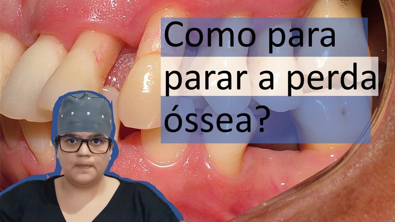 Como parar a perda óssea? | Dra Bianca Rosa