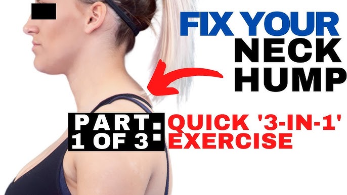 Understanding And Addressing Neck Humps 2024