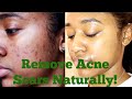 Essential Oils For Acne Scars