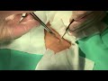 粉瘤くりぬき法 30代女性胸epidermal cyst atheroma cystic acne extractions 脂肪腫 lipoma クリニーク大阪心斎橋 大阪梅田・名古屋・福岡・神戸院