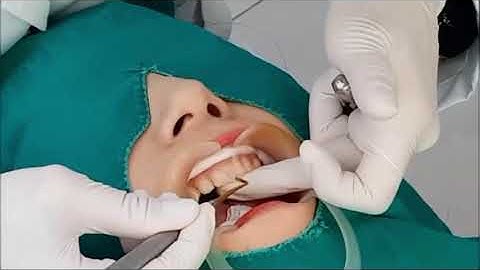 앞니레진, 앞니레진 실시간 치료설명, Diastema resin closure real time, anterior direct resin treatment