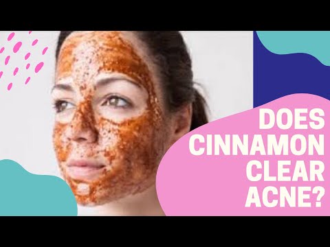 Does Cinnamon Clear Acne?