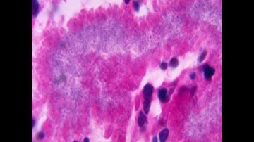 Nocardiosis: Nocardia asteroides