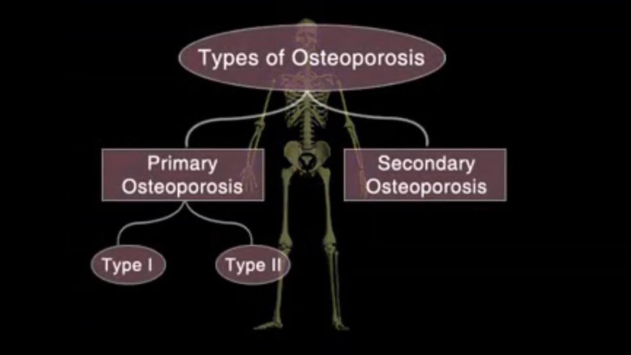 Osteoporosis: 3D medical animation - YouTube