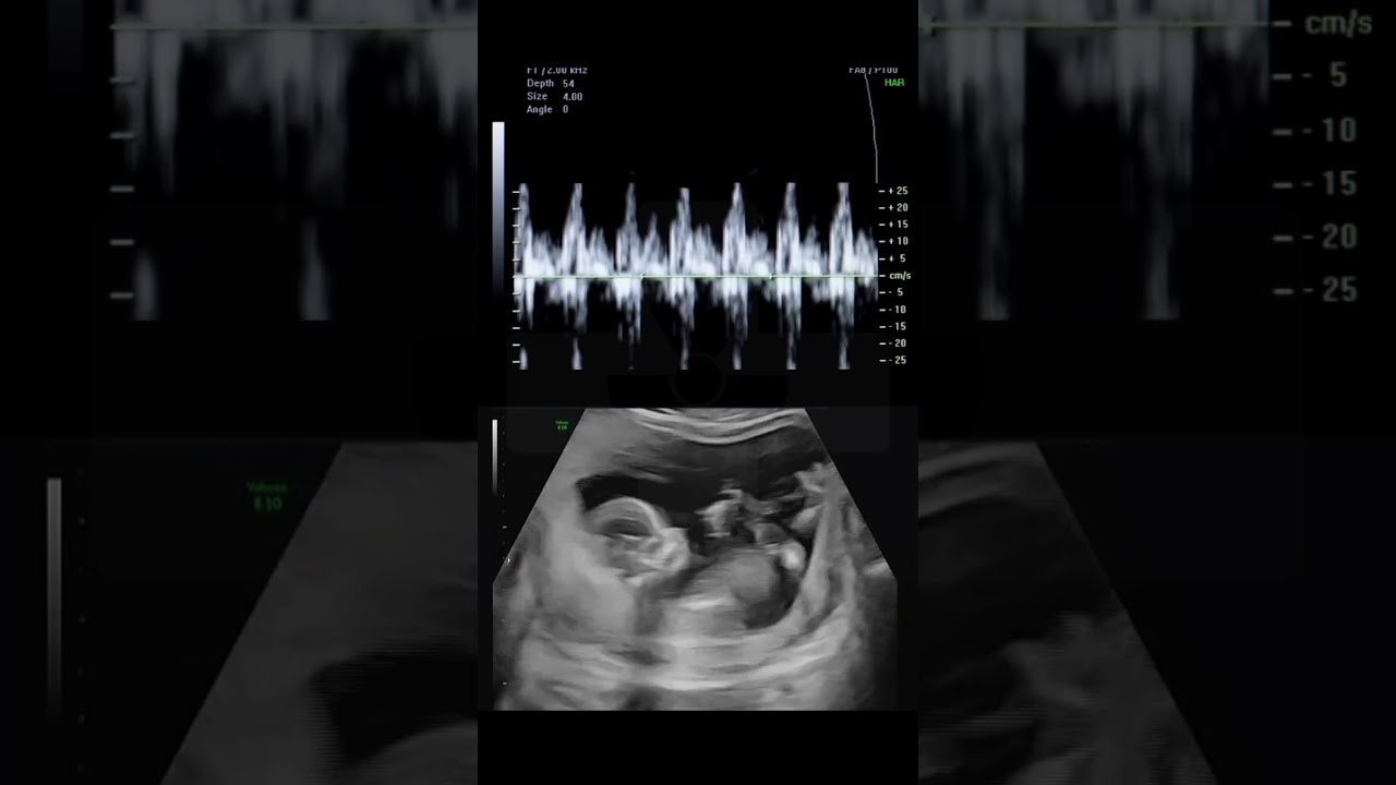 This Is What A Baby S Heartbeat Sounds Like During An Ultrasound Science Natal Shorts