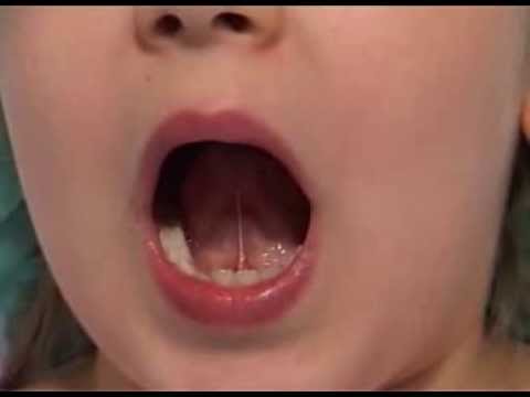 Que pasa si se te corta el frenillo de la lengua