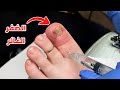 شاهد ما هو الظفر الغائر وكيف يتم علاجة Ingrown Toenail Removal 