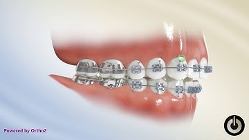 Elastics, Class II Triangle U3 to L34 | Dental Braces | Temecula Valley, CA