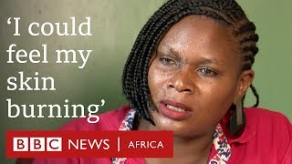 Ugandan acid attack survivors speak out - BBC Africa