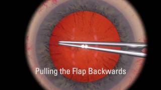 Little Capsulorhexis Rescue Maneuver on Eyesi Surgical Simulator