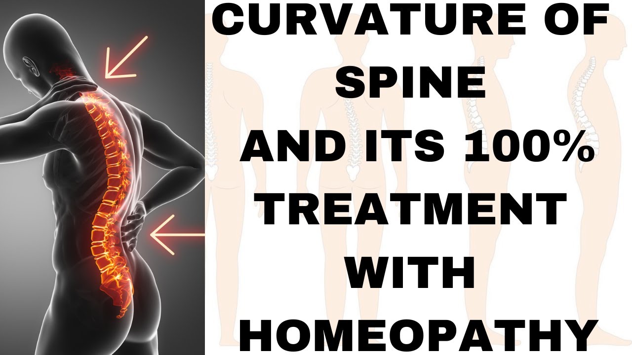 CURVATURE OF SPINE || SPINAL CURVATURE || BEST HOMEOPATHIC MEDICINE FOR CURVATURE OF SPINE !