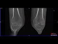 Knee Osteoarthritis Weight Bearing CT Evaluation
