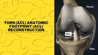 Torn ACL   Anatomic Footprint ACL Reconstruction