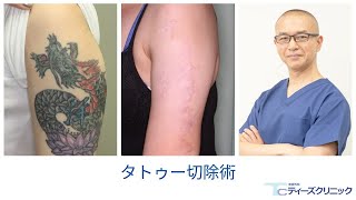 東京でタトゥー 刺青 除去ならレーザーから植皮手術のティーズクリニックへ 東京でタトゥー 刺青 除去ならレーザーから植皮手術のティーズクリニックへ