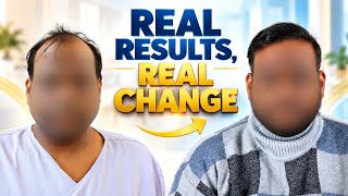 12 Months After Hair Transplant: The Before & After Result at Saraswat Hospital, Agra, India 