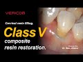 [Vericom]Cervical resin filling  Class V Composite resin restoration