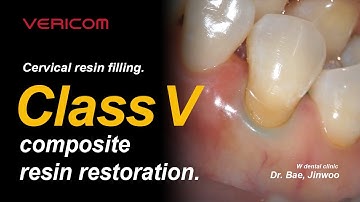 Cervical resin filling  Class V Composite resin restoration