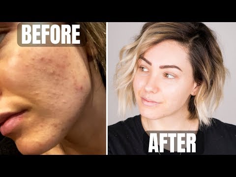 SKINCARE ROUTINE || acne prone skin